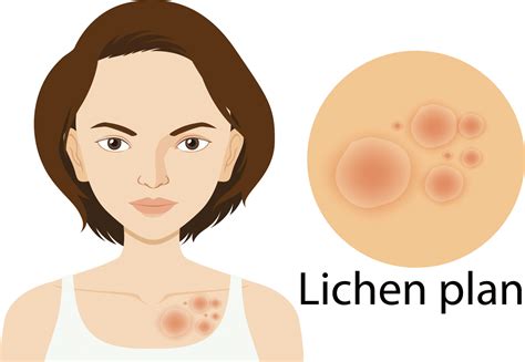 Lichen plan causes symptômes et traitements