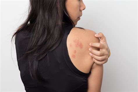 Acute Urticaria Symptoms Causes And Treatment