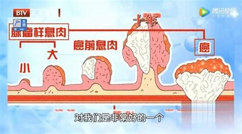 息肉是癌症的前兆？到底要不要切？收好这份判断标准澎湃号·湃客澎湃新闻 The Paper