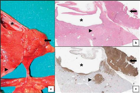 Renal Angiomyolipoma Gross