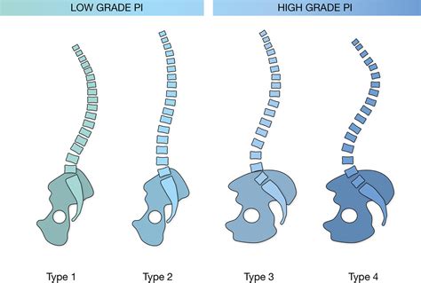 Low Lordosis Is A Common Finding In Young Lumbar Disc Herniation