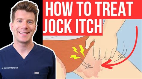 Doctor Explains How To Recognise And Treat Jock Itch Aka Tinea Cruris