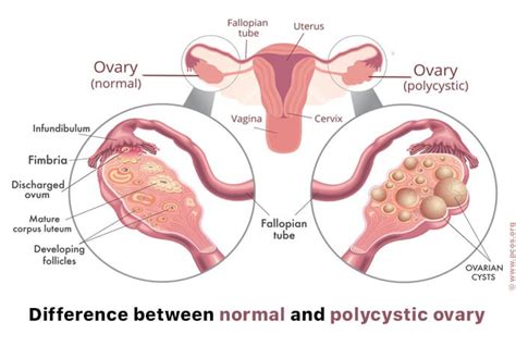 Pathophysiology And Clinical Presentation Polycystic Ovarian Syndrome