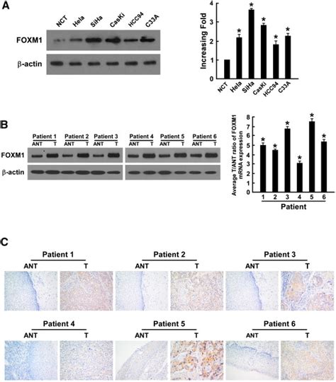 Foxm1 Promotes Tumor Cell Invasion And Correlates With Poor Prognosis