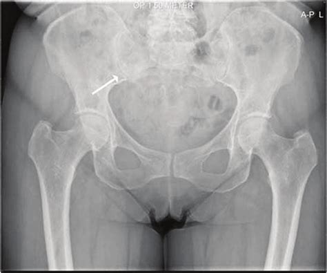 Plain Radiograph Of Patient 3 Showing Signs Of Sacroiliitis On The Download Scientific Diagram