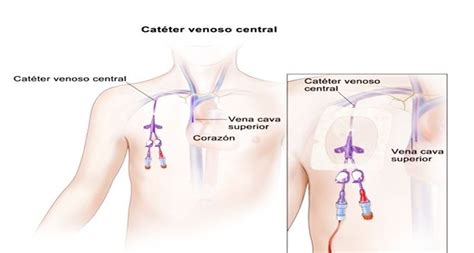 Cat Ter Venoso Central Cvc Cat Ter Venoso Central Cateter