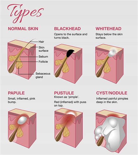 Types of Acne Skin Advice, Skin Tips, Facial Skin Care Routine, Face Skin Care, Acne Treatment ...