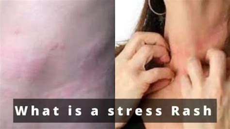 What Does A Stress Face And Hand Rash Look Like And Treatment