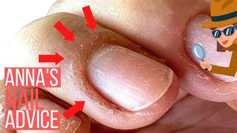 Thinking About Gel Polish You Need To Know Why This Happens [allergic