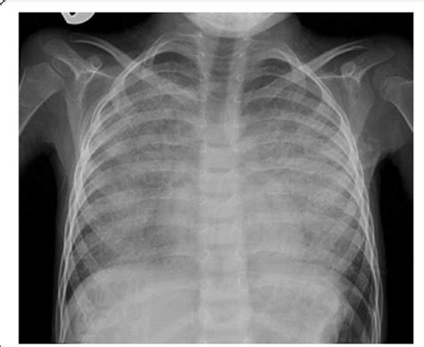 Chest X-ray showed widespread bilateral air-space disease | Download Scientific Diagram