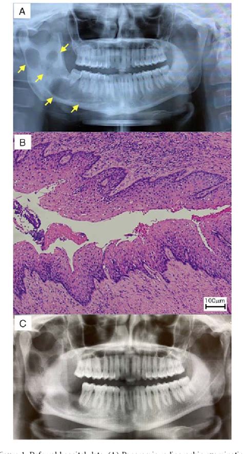 Figure From Odontogenic Keratocyst In The Mandibular Condyle Base