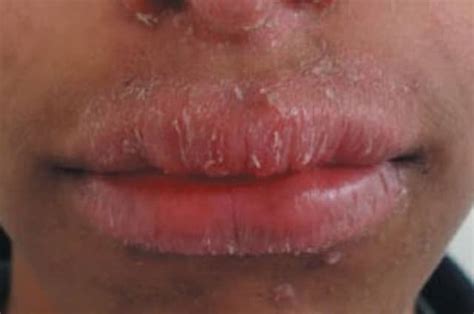 Skin Lesions On Lips