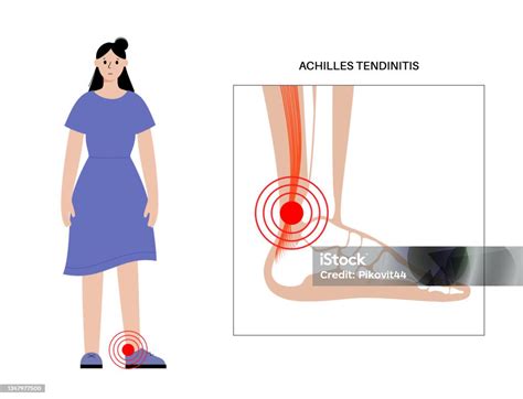 Cedera Tendon Achilles Ilustrasi Stok Unduh Gambar Sekarang