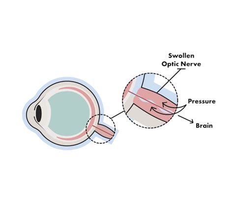 Papilledema (Optic Disc Swelling): Causes Symptoms, 47% OFF