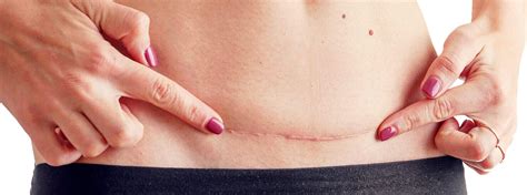 Vancouver Laser Scar Removal Scar Revision Surrey Surgery Injections