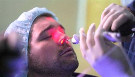 Balloon Sinuplasty To Treat Chronic Nasal Congestion 2025