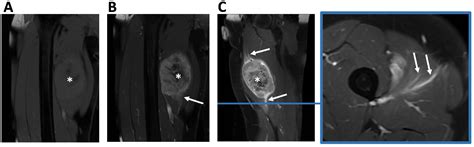 Role Of Imaging In Initial Prognostication Of Locally Advanced Soft