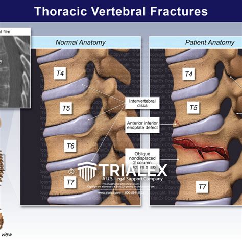 Thoracic Vertebral Fractures - TrialExhibits Inc.