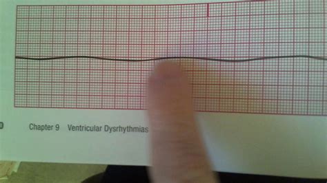 Agonal and Asystole - YouTube