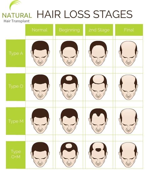 Male Pattern Hair Loss Stages