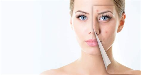 Goodbye To Acne And Scars With Effective Treatments Advanced Aestheticspune