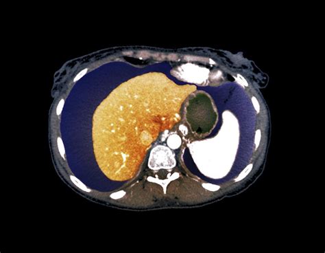 Chronic Liver Disease Ct Scan By Zephyr