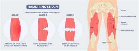 Hamstring Injury: Causes, Symptoms And Treatment