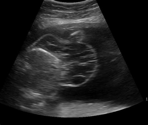 Cystic Hygroma Antenatal Ultrasound Image