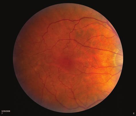 A Color Photograph Of A Normal Macula The Normal Retinal Vasculature Download Scientific