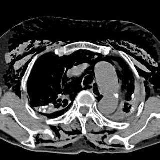 Chest CT Scan Shows Extensive Mediastinal And Subcutaneous Emphysema