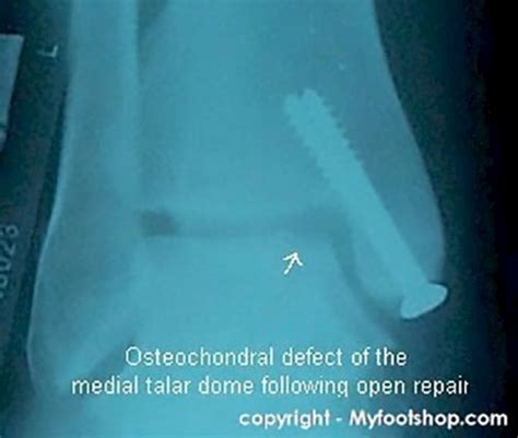 Talar Dome Fractures Causes And Treatment Options MyFootShop