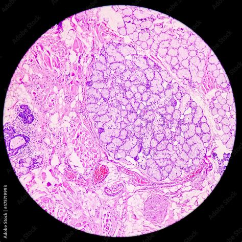 Tongue with mandible cancer, oral cancer, Invasive squamous cell ...