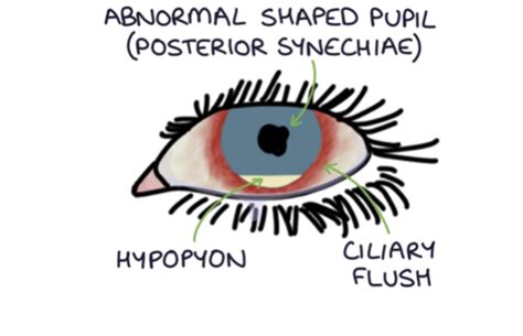 Anterior Uveitis Flashcards Quizlet