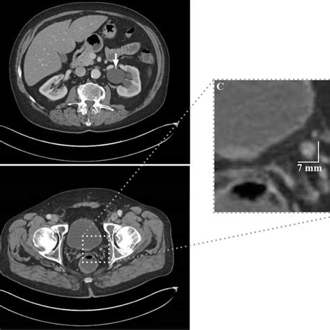 Computed Tomography CT Of The Abdomen And Pelvis Cross Sectional