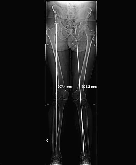 The Assessment Of Limb Length Discrepancy Before Total Hip Arthroplasty The Journal Of