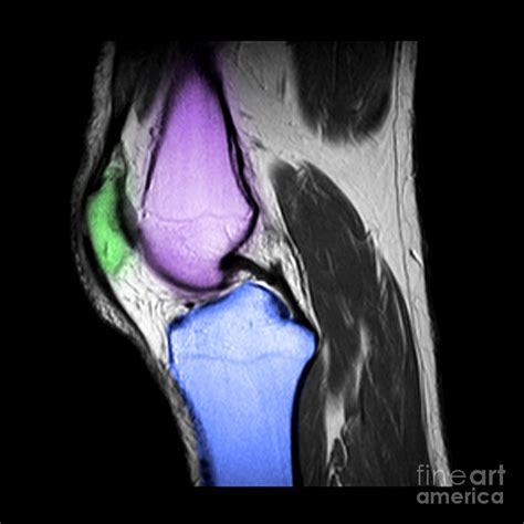 Mri, Normal Kneenormal Knee Photograph by Living Art Enterprises - Pixels