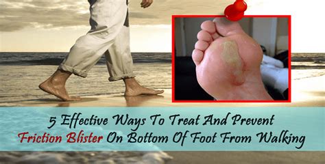 5 Effective Ways To Treat And Prevent Friction Blister On Bottom Of