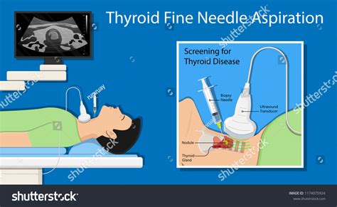 Thyroid Ultrasound Scan Royalty-Free Images, Stock Photos & Pictures ...