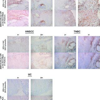 PD L1 Staining Pattern Using PD L1 IHC 22C3 PharmDx And The 22C3