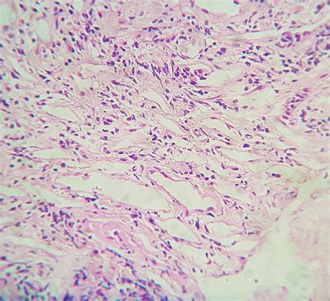 H And E Primary Intestinal Lymphangiectasia Showing Numerous Dilated Download Scientific Diagram