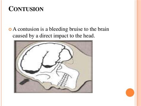 Head Injury Ppt