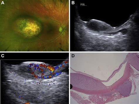 Extrascleral Extension From Choroidal Melanoma Diagnosed On Doppler