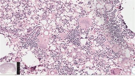 Epulis Histology