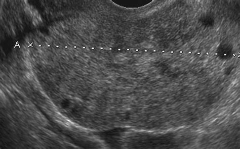 Ovarian Torsion Ultrasound Findings