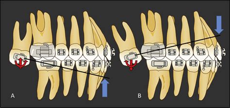 A A Maxillary Second Molar Extruded With Distal Crown Tipping Upon Download Scientific