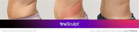 Trusculpt Id Nyc Customized Body Contouring Treatments