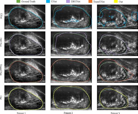 Figure From Microsegnet A Deep Learning Approach For Prostate