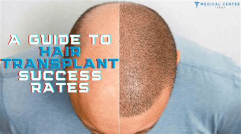 A Guide To Hair Transplant Success Rates Mct