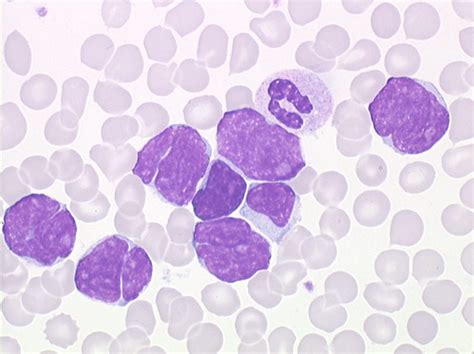 T Cell Lymphoma Blood Smear Sezary Syndrome Cell Atlas Of Images And