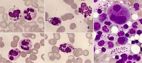 Leishmaniae In PB Neutrophils